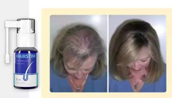 Efectele secundare ale produsului Hairstim pentru creșterea părului: ce trebuie să știi