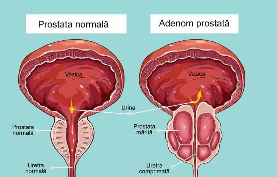 Cumpărați Revitaprost în Bacău – Pentru tratarea problemele de prostată