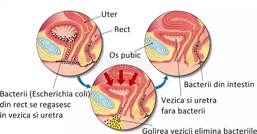 Uromexil în Botoșani: cum să combați eficient infecțiile urinare